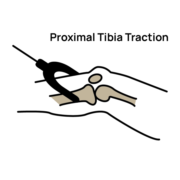 Why or why not skeletal traction? Arbutus Medical